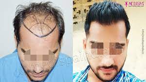 Do S And Don Ts After A Hair Transplant Surgery Hair Transplant Results Hair Transplant Cost Best Hair Transplant