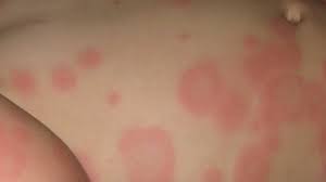 Image result for Erythema Multiforme Major
