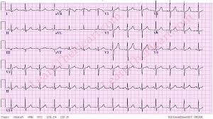 introduction to ecg online 12 lead ecg interpretation