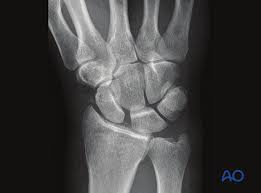 Image result for Scapholunate Dislocation