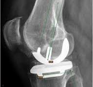 Posterior tibial slope 10 ; femoral component in 3.8 flexion ...