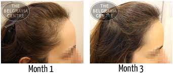 If you're experiencing hair loss, it may be caused by stress. Women Now Losing Hair In Their 20s Thanks To Stress