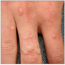 Image result for verrucae filiformes