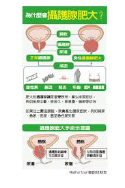 3招預防攝護腺肥大- paulhsu333 的部落格- udn部落格