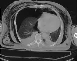 Image result for Open Pneumothorax