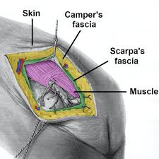 incisional hernia risk factors clinical features