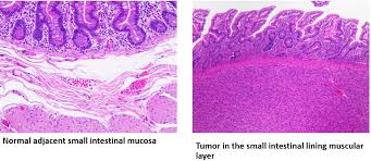 Image result for Small Intestinal Bleeding