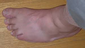 Image result for gout symptoms toe
