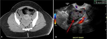 Learn vocabulary, terms and more with flashcards, games and other study tools. Non Visualization Of The Ovary On Ct Or Ultrasound In The Ed Setting Utility Of Immediate Follow Up Imaging Springerlink