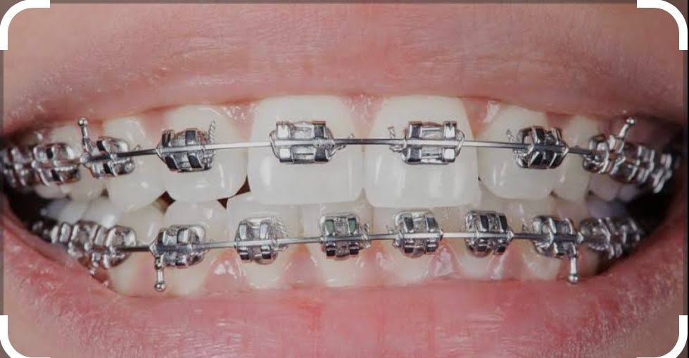 METAL BRACES product image