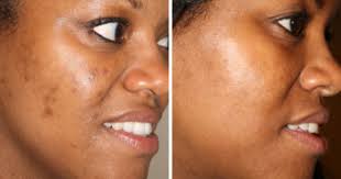 I tried a chemical peel to zap dark spots on my face—and it worked. Is It Safe To Peel Dark Skin Tones
