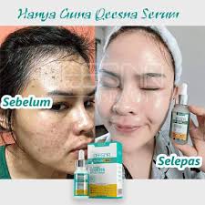 Find many great new & used options and get the best deals for qeesna serum vit c whitening booster for freckles no.7 laboratories line correcting booster serum 15ml new. Qeesna Serumm Jeragat Home Facebook