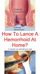 9 Healthy Tricks How To Relieve Severe Hemorrhoid Itch Hemorrhoid Remedies Fast Can Hemorrhoids Grow Back After Surgery How Can You Get Hemorrhoids What Fo Ange