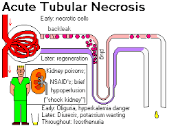 Kidney Disease Kidney Kidney Disease Nsaids