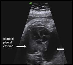 Pleural effusion is an accumulation of fluid in the pleural cavity between the lining of the lungs and the thoracic cavity (i.e., the visceral and parietal pleurae). Late Onset Fetal Bilateral Pleural Effusions Associated With Down Syndrome Sciencedirect