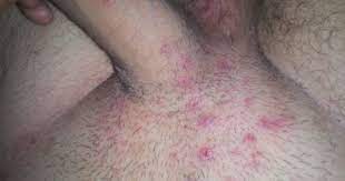 When properly used, it gently exfoliates the skin removing dead cells and help pull out the hair out of the skin. Ingrown Hair On Penis Get Rid Remove Bumps On Penile Shaft Base Treat Male Groin Area Ingrown Hair