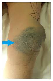 I'm using this product across a rather large area (my inner forearm) after a tattoo artist went too hard with the needle and left minimal i started using this about a six weeks ago on the knee replacement scar i have. Apparent Skin Discoloration About The Knee Joint A Rare Sequela Of Metallosis After Total Knee Replacement Abstract Europe Pmc