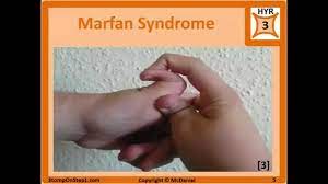 Marfan Syndrome Osteogenesis Imperfecta Ehlers Danlos Blue Sclera Hypermobile Joints Stretchy Youtube