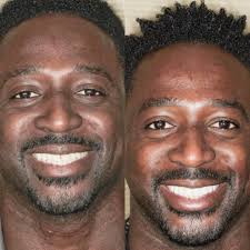 Porcelain veneers enhanced this good look guy's smile to a “10”. Clickbl  link in bio for you free estimate #restondentist #restoncosmeticdentist  #bestdentistnorthernvirginia #bestdentistinmyarea #cosmeticdentistmclean  #cosmeticdentistloudouncounty ...