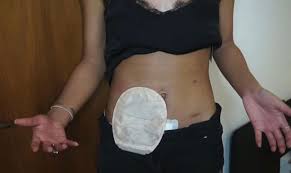 Crohn S Disease Sufferer Forced To Show Nightclub Bouncer Colostomy Bag Mirror Online