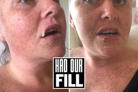My lips exploded with pus after £60 botched fillers pierced a blood vessel  and left me permanently disfigured