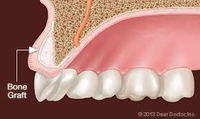 What to eat after tooth extraction and bone graft. Bone Grafting Dentist Mentor Oh Dental Education Library