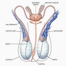 Image result for Varicocele