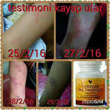 Penyebab, simptom, komplikasi dan rawatan. Sembuhkan Kayap Dengan Cepat Cara Semulajadi Ohcantik Com