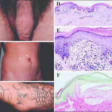 The only permanent hair removal is electrolysis. A Numerous Flesh Colored Flat Shiny Papules Are Distributed On The Download Scientific Diagram