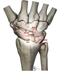 Due to this troublesome movement, a torn ligament in wrist can cause problems, and pain with wrist movement is the commonest symptom of it. Scapholunate Instability An Update Radsource