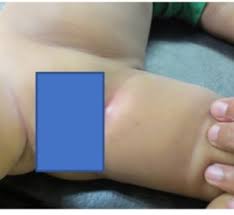 Image result for Galeazzi Sign