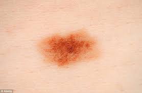 If you have skin cancer, it is important to know which type you have because it affects your treatment options and your outlook (prognosis). The 68k A Year Skin Cancer Wonder Drug On The Nhs Daily Mail Online