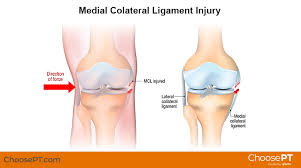 Lax ligaments, or ligament laxity, may occur anywhere in the body and can be a major cause of chronic pain. Physical Therapy Guide To Medial Collateral Ligament Mcl Injury Choosept Com