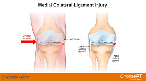 The wrist and knee are common joints for dogs to sprain. Physical Therapy Guide To Medial Collateral Ligament Mcl Injury Choosept Com
