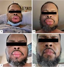 Image result for Angioedema