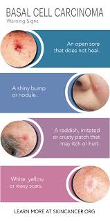 Image result for skin cancer on nose pimple