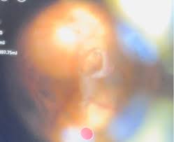 Image result for Floaters