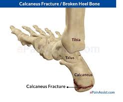 Foot Bones Diagram 3 4 Medial Posterior View Calcaneus Fracture Epainassist Com