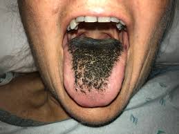 Ursachen wer jetzt glaubt, aphthen auf der zunge entstehen wie pickel und pusteln im gesicht durch verstopfte talgdrüsen, liegt falsch. Schwarze Haarzunge Nebenwirkung Von Antibiotika Der Spiegel