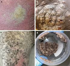 Image result for scabies effects on the human body