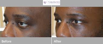 One of the most common ways to get styes is by transferring bacteria from your hands to your eyes.16 x trustworthy source mayo clinic educational website from one of the world's leading. Almond Eye Surgery Photos Mehryar Ray Taban Md