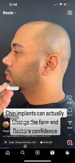 bruce spotted liking a chin implant instagram reel, surgery coming? :  r/BruceDropEmOff