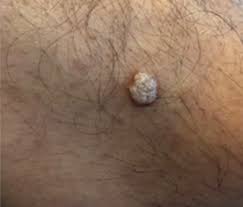 Lesiones por virus del papiloma humano en pacientes urológicos | Revista  Mexicana de Urología