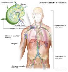 Enfermedad de hodgkin, cáncer de hodgkin, tumor hodgkin. Tratamiento Del Linfoma De Hodgkin En Adultos Pdq Version Para Pacientes Instituto Nacional Del Cancer