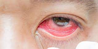 Infeksi mata yang sering terjadi adalah mata berwarna merah muda yang disebabkan oleh virus tertentu. 3 Cara Mudah Mengatasi Mata Merah Halaman All Kompas Com