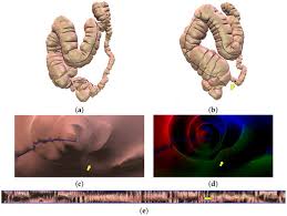 Image result for Virtual Colonoscopy