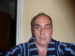 Bee stings and how to deal with them