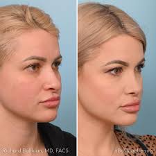 💃 Patient: 34 year old female 👱🏻‍♀️Treatment: Septoplasty with  Rhinoplasty 🎯 Purpose: Septoplasty to improve her breathing and  Rhinoplasty for hump to go down, softer tip and narrowing nostrils so they  are