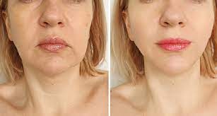 Thread lift before and after jowls. Pdo Thread Lift Scottsdale Skin Tightening Phoenix