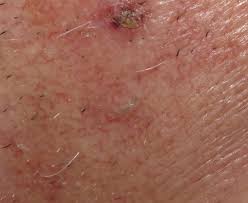 That's also why many ingrown hairs occur in the pubic area, because hair tends to be curlier down there. How To Get Rid Of Ingrown Hair And Ingrown Hair Prevention